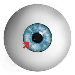 A-scratch-on-your-outer-eye-or-Corneal-Abraison