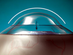 Conductive-Keratoplasty-Makes-the-Cornea-Steeper