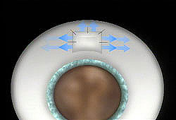Diagram-of-Filtration-Surgery
