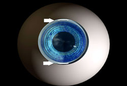 Limbal-Relaxing-Incisions-can-be-used-to-treat-multiple-conditions