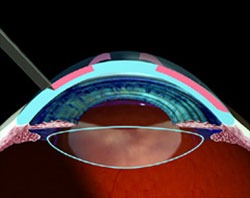 Radial-Keratotomy-Treats-Myopia